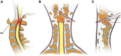 The clinical validity of atlantoaxial joint inclination angle and reduction index for atlantoaxial dislocation